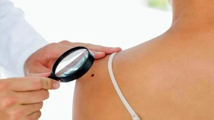 Investigadores del IPN desarrollan innovador tratamiento contra el melanoma
