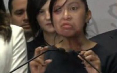 Solicita Senado atención médica y psicológica gratuita a víctimas de ataques con ácido