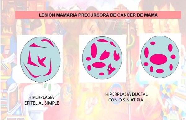 CAPACITA SALUD A SU PERSONAL EN PREVENCION, DETECCIÓN Y TRATAMIENTO DE CÁNCER DE MAMA