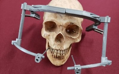 Crea IPN dispositivo mecánico impreso en 3D para corregir deformaciones craneales