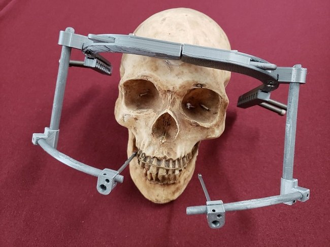 Crea IPN dispositivo mecánico impreso en 3D para corregir deformaciones craneales