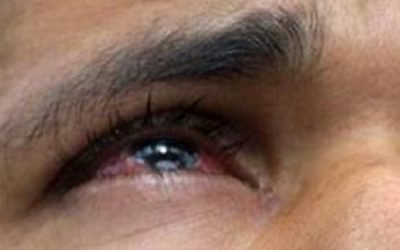 Hospital Juárez de México devuelve la vista a 60 pacientes con cirugías de catarata