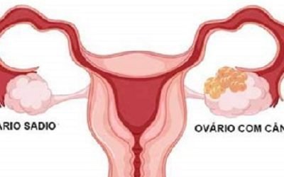 CÁNCER DE OVARIO; EL SEGUNDO MÁS MORTAL ENTRE PADECIMIENTOS GINECOLÓGICOS