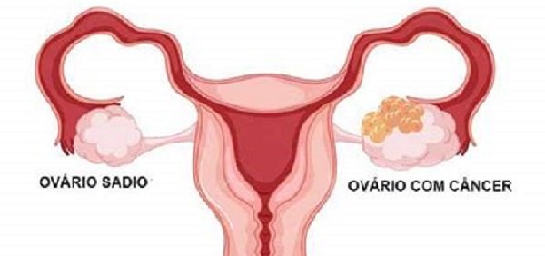 CÁNCER DE OVARIO; EL SEGUNDO MÁS MORTAL ENTRE PADECIMIENTOS GINECOLÓGICOS