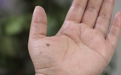 LUNARES CON ALTERACIONES PUEDEN SER CANCERÍGENOS