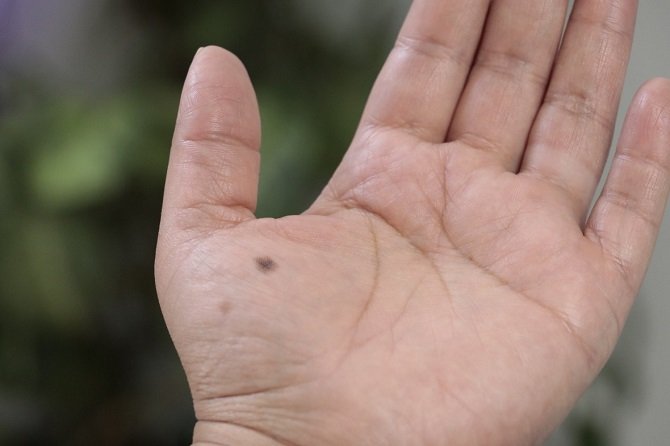 LUNARES CON ALTERACIONES PUEDEN SER CANCERÍGENOS