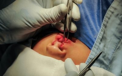DEVUELVE IMIEM SONRISAS A LA NIÑEZ MEXIQUENSE CON LABIO Y PALADAR HENDIDO AL REALIZAR MÁS DE 42 MIL ATENCIONES