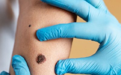 Cofepris aprueba ensayo clínico para vacuna innovadora contra melanoma
