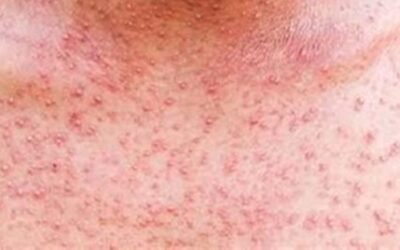 Suman ya 31 defunciones por sarampión en México