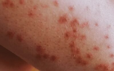 POR EL DESABASTO Y NEGLIGENCIA DE MORENA, MÉXICO VUELVE A ENFRENTAR EL SARAMPIÓN: PRI