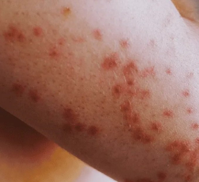 POR EL DESABASTO Y NEGLIGENCIA DE MORENA, MÉXICO VUELVE A ENFRENTAR EL SARAMPIÓN: PRI